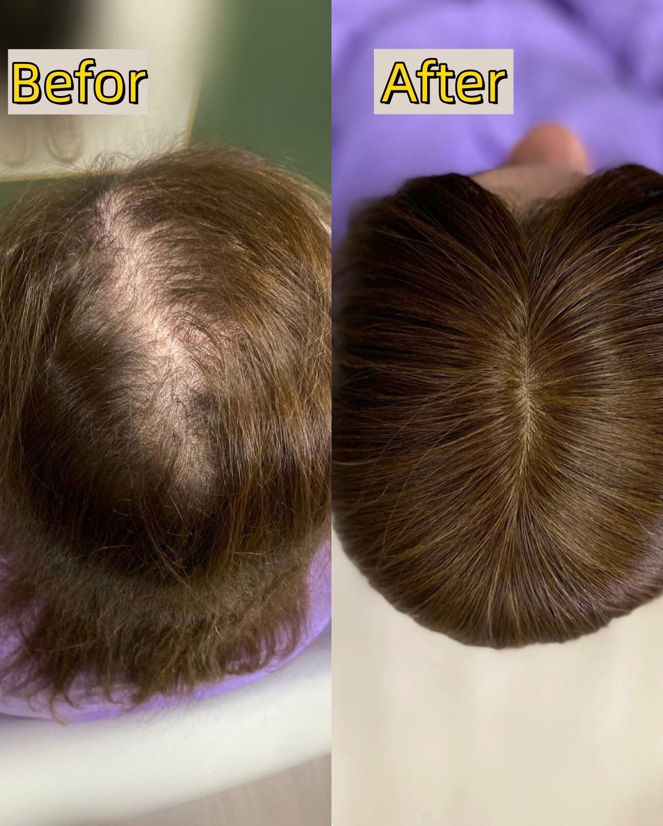 🔥Straight Hair Topper for Crown Thinning – Natural Coverage at the Crown